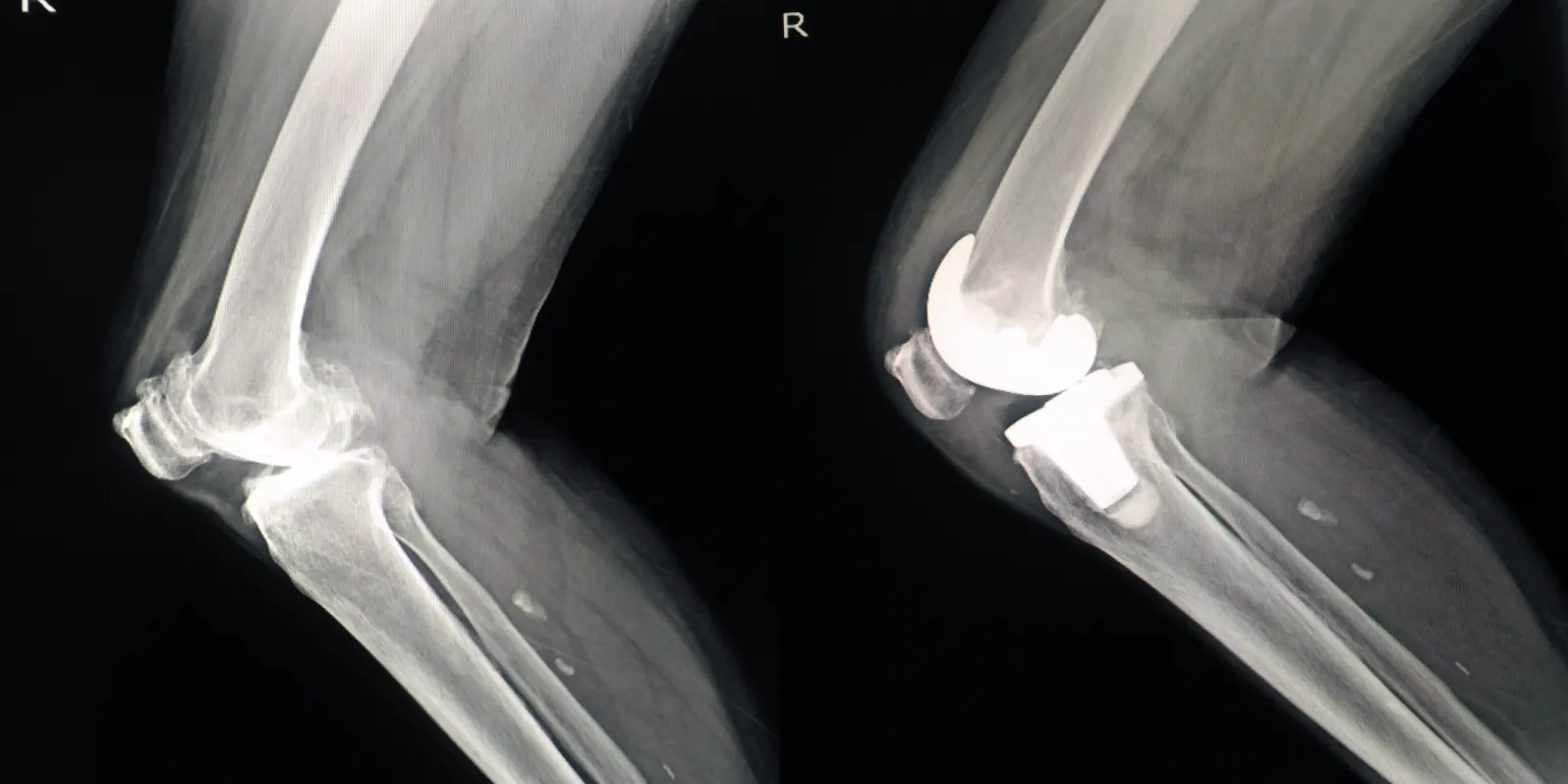 Here is an xray of a random knee joint.&nbsp;
